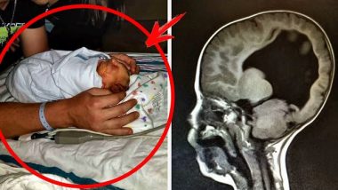 Այս երեխան ծնվել է առանց գլխուղեղի. կապշեք, երբ տեսնեք, թե ինչպիսին է նա տարիներ անց